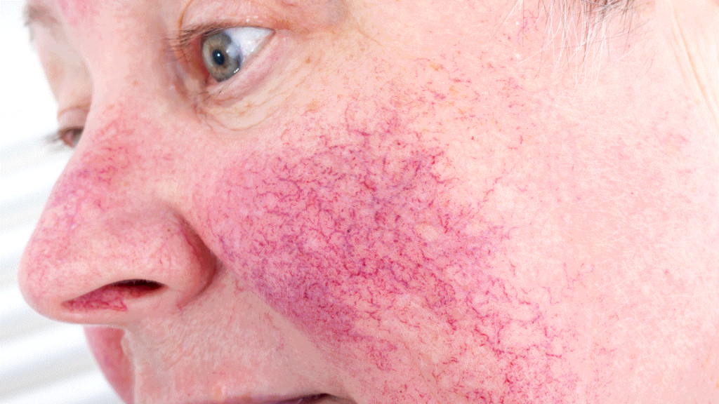 Rosacea And Acne Have Subtle Differences